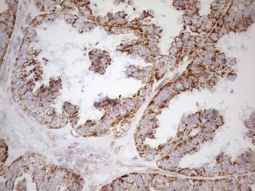 NAPSA / NAPA / Napsin A Antibody - Immunohistochemical staining of paraffin-embedded Adenocarcinoma of Human ovary tissue using anti-NAPSA mouse monoclonal antibody. (Heat-induced epitope retrieval by 1mM EDTA in 10mM Tris buffer. (pH8.5) at 120°C for 3 min. (1:150)
