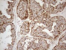NAPSA / NAPA / Napsin A Antibody - Immunohistochemical staining of paraffin-embedded Adenocarcinoma of Human ovary tissue using anti-NAPSA mouse monoclonal antibody. (Heat-induced epitope retrieval by 1mM EDTA in 10mM Tris buffer. (pH8.5) at 120°C for 3 min. (1:150)