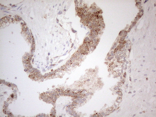 NAPSA / NAPA / Napsin A Antibody - Immunohistochemical staining of paraffin-embedded Carcinoma of Human prostate tissue using anti-NAPSA mouse monoclonal antibody. (Heat-induced epitope retrieval by 1mM EDTA in 10mM Tris buffer. (pH8.5) at 120°C for 3 min. (1:150)