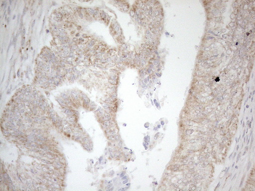 NAPSA / NAPA / Napsin A Antibody - Immunohistochemical staining of paraffin-embedded Adenocarcinoma of Human colon tissue using anti-NAPSA mouse monoclonal antibody. (Heat-induced epitope retrieval by 1mM EDTA in 10mM Tris buffer. (pH8.5) at 120°C for 3 min. (1:150)