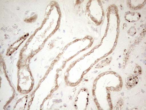 NAPSA / NAPA / Napsin A Antibody - Immunohistochemical staining of paraffin-embedded Carcinoma of Human kidney tissue using anti-NAPSA mouse monoclonal antibody. (Heat-induced epitope retrieval by 1mM EDTA in 10mM Tris buffer. (pH8.5) at 120°C for 3 min. (1:150)