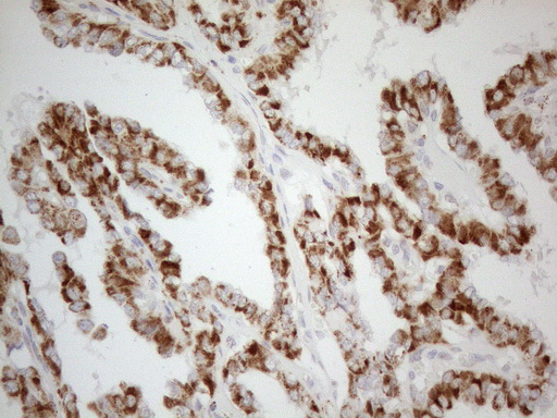 NAPSA / NAPA / Napsin A Antibody - Immunohistochemical staining of paraffin-embedded Carcinoma of Human thyroid tissue using anti-NAPSA mouse monoclonal antibody. (Heat-induced epitope retrieval by 1mM EDTA in 10mM Tris buffer. (pH8.5) at 120°C for 3 min. (1:150)