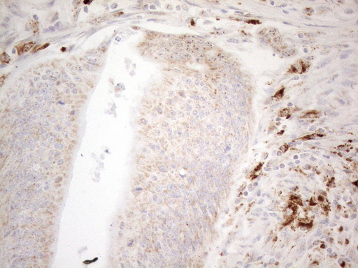 NAPSA / NAPA / Napsin A Antibody - Immunohistochemical staining of paraffin-embedded Adenocarcinoma of Human colon tissue using anti-NAPSA mouse monoclonal antibody. (Heat-induced epitope retrieval by 1mM EDTA in 10mM Tris buffer. (pH8.5) at 120°C for 3 min. (1:150)