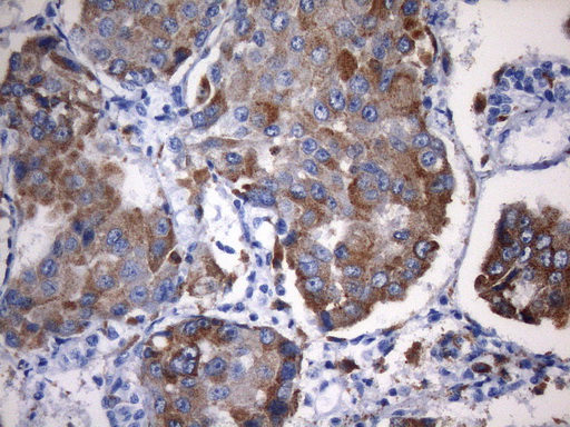 NAPSA / NAPA / Napsin A Antibody - Immunohistochemical staining of paraffin-embedded carcinoma of human lung tissue using anti-NAPSA mouse monoclonal antibody. HIER pretreatment with 1mM EDTA in 10mM Tris buffer. (pH8.0) at 120°C for 2.5 minutes.was diluted 1:40000 and detected with HRP secondary and DAB chromogen. Strong cytoplasmic and membraneous staining seen in the tumor cells.