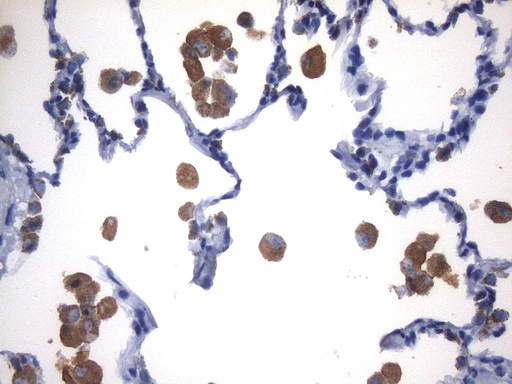 NAPSA / NAPA / Napsin A Antibody - Immunohistochemical staining of paraffin-embedded human lung tissue located within the normal limits of tumor using anti-NAPSA mouse monoclonal antibody. HIER pretreatment was with 1mM EDTA in 10mM Tris buffer. (pH8.0) at 120°C for 2.5 min,was diluted 1:40000 and detected with HRP-DAB. Strong cytoplasmic and membrane staining seen in the macrophages and pneumocyte. Other cell types in lung are negative.