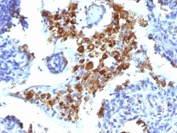 NAPSA / NAPA / Napsin A Antibody - Formalin-fixed, paraffin-embedded human lung Adenocarcinoma stained with Napsin-A antibody (NAPSA/1238).  This image was taken for the unmodified form of this product. Other forms have not been tested.