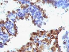 NAPSA / NAPA / Napsin A Antibody - Formalin-fixed, paraffin-embedded human lung adenocarcinoma stained with Napsin-A antibody (NAPSA/1238 + NAPSA/1239).  This image was taken for the unmodified form of this product. Other forms have not been tested.
