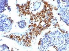 NAPSA / NAPA / Napsin A Antibody - Formalin-fixed, paraffin-embedded human lung adenocarcinoma stained with Napsin-A antibody (NAPSA/1239).  This image was taken for the unmodified form of this product. Other forms have not been tested.