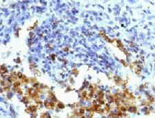 NAPSA / NAPA / Napsin A Antibody - IHC testing of FFPE human lung adenocarcinoma with Napsin-A antibody (clone NPSNA-1).  This image was taken for the unmodified form of this product. Other forms have not been tested.