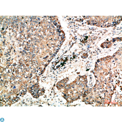 NAPSA / NAPA / Napsin A Antibody - Immunohistochemical analysis of paraffin-embedded human-lung-cancer, antibody was diluted at 1:200.