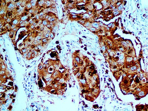NAPSA / NAPA / Napsin A Antibody - IHC of Napsin A on a FFPE Lung Carcinoma Tissue