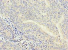 NAR / CPSF4 Antibody - Immunohistochemistry of paraffin-embedded human endometrial cancer at dilution 1:100