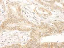 NARG1 / NAA15 Antibody - Detection of Human NARG1 by Immunohistochemistry. Sample: FFPE section of human stomach carcinoma. Antibody: Affinity purified rabbit anti-NARG1 used at a dilution of 1:250.