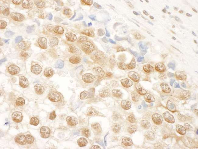NARG1 / NAA15 Antibody - Detection of Human NARG1 by Immunohistochemistry. Sample: FFPE section of human testicular seminoma. Antibody: Affinity purified rabbit anti-NARG1 used at a dilution of 1:250.