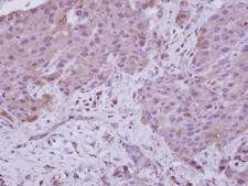 NARG1 / NAA15 Antibody - IHC of paraffin-embedded Breast ca, using NARG1 antibody at 1:250 dilution.