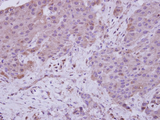NARG1 / NAA15 Antibody - IHC of paraffin-embedded Breast ca, using NARG1 antibody at 1:250 dilution.