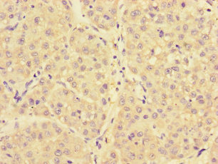 NARS Antibody - Immunohistochemistry of paraffin-embedded human liver cancer using NARS Antibody at dilution of 1:100