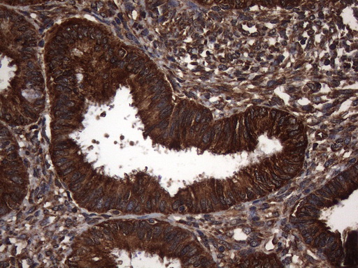 NARS2 Antibody - Immunohistochemical staining of paraffin-embedded Adenocarcinoma of Human endometrium tissue using anti-NARS2 mouse monoclonal antibody. (Heat-induced epitope retrieval by 1mM EDTA in 10mM Tris buffer. (pH8.5) at 120°C for 3 min. (1:150)