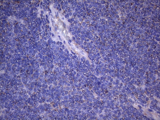 NARS2 Antibody - Immunohistochemical staining of paraffin-embedded Human lymphoma tissue using anti-NARS2 mouse monoclonal antibody. (Heat-induced epitope retrieval by 1mM EDTA in 10mM Tris buffer. (pH8.5) at 120°C for 3 min. (1:150)