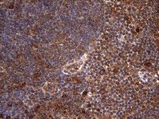 NARS2 Antibody - Immunohistochemical staining of paraffin-embedded Carcinoma of Human lung tissue using anti-NARS2 mouse monoclonal antibody. (Heat-induced epitope retrieval by 1mM EDTA in 10mM Tris buffer. (pH8.5) at 120°C for 3 min. (1:150)