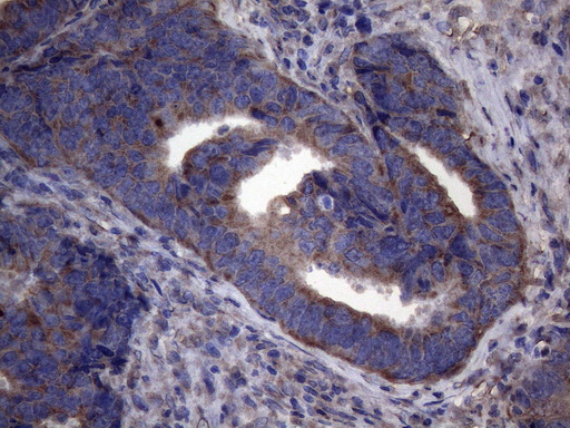NARS2 Antibody - Immunohistochemical staining of paraffin-embedded Adenocarcinoma of Human colon tissue using anti-NARS2 mouse monoclonal antibody. (Heat-induced epitope retrieval by 1mM EDTA in 10mM Tris buffer. (pH8.5) at 120°C for 3 min. (1:150)