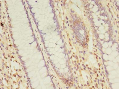 NARS2 Antibody - Immunohistochemistry of paraffin-embedded human colon cancer using antibody at dilution of 1:100.