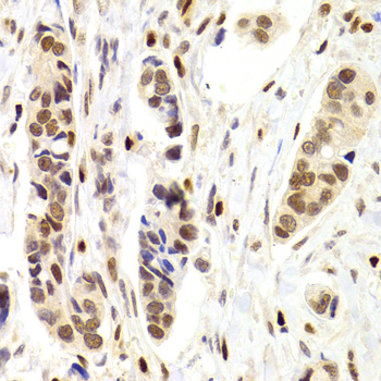 NASP Antibody - Immunohistochemistry of paraffin-embedded Human mammary cancer tissue.