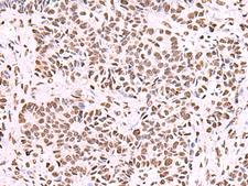 NASP Antibody - Immunohistochemistry of paraffin-embedded Human ovarian cancer tissue  using NASP Polyclonal Antibody at dilution of 1:55(×200)