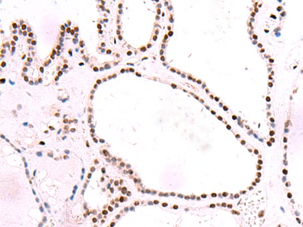 NASP Antibody - Immunohistochemistry of paraffin-embedded Human thyroid cancer tissue  using NASP Polyclonal Antibody at dilution of 1:55(×200)