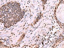 NASP Antibody - Immunohistochemistry of paraffin-embedded Human esophagus cancer tissue  using NASP Polyclonal Antibody at dilution of 1:60(×200)