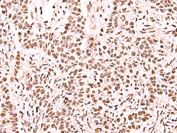 NASP Antibody - Immunohistochemistry of paraffin-embedded Human ovarian cancer tissue  using NASP Polyclonal Antibody at dilution of 1:60(×200)