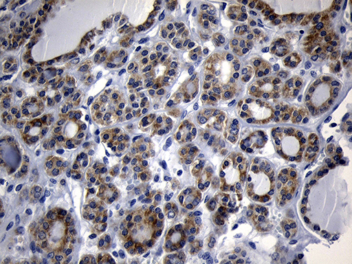 NAT1 / AAC1 Antibody - Immunohistochemical staining of paraffin-embedded Carcinoma of Human thyroid tissue using anti-NAT1 mouse monoclonal antibody. (Heat-induced epitope retrieval by 1mM EDTA in 10mM Tris buffer. (pH8.5) at 120°C for 3 min. (1:500)