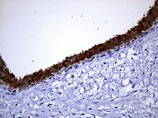 NAT1 / AAC1 Antibody - Immunohistochemical staining of paraffin-embedded Human breast tissue within the normal limits using anti-NAT1 mouse monoclonal antibody. (Heat-induced epitope retrieval by 1mM EDTA in 10mM Tris buffer. (pH8.5) at 120°C for 3 min. (1:500)