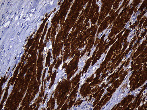 NAT1 / AAC1 Antibody - Immunohistochemical staining of paraffin-embedded Adenocarcinoma of Human breast tissue tissue using anti-NAT1 mouse monoclonal antibody. (Heat-induced epitope retrieval by 1mM EDTA in 10mM Tris buffer. (pH8.5) at 120°C for 3 min. (1:500)