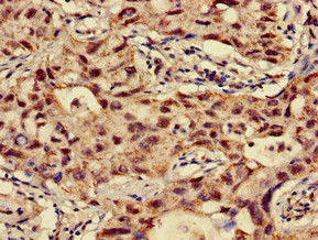 NAT1 / AAC1 Antibody - Immunohistochemistry of paraffin-embedded human lung cancer at dilution of 1:100