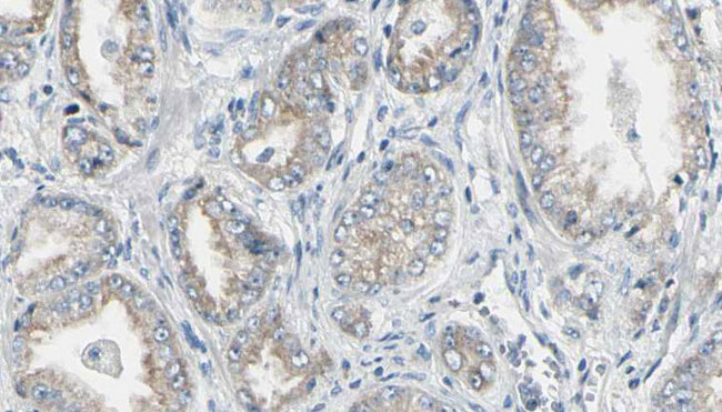 NAT1 / AAC1 Antibody - 1:100 staining human prostate tissue by IHC-P. The sample was formaldehyde fixed and a heat mediated antigen retrieval step in citrate buffer was performed. The sample was then blocked and incubated with the antibody for 1.5 hours at 22°C. An HRP conjugated goat anti-rabbit antibody was used as the secondary.