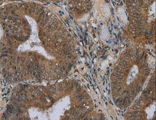 NAT10 Antibody - Immunohistochemistry of paraffin-embedded Human colon cancer using NAT10 Polyclonal Antibody at dilution of 1:40.