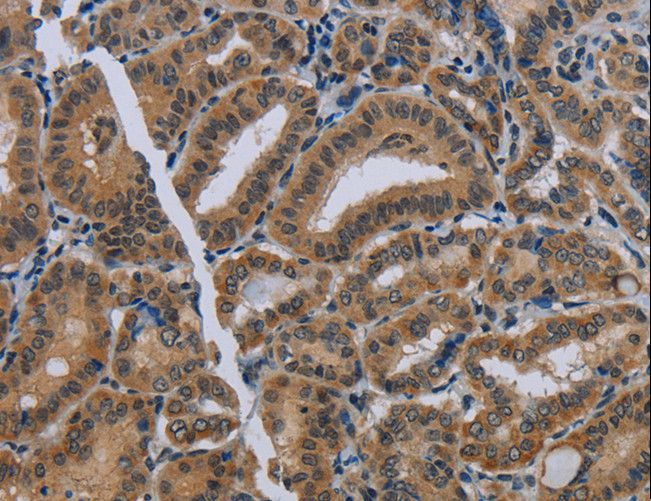 NAT10 Antibody - Immunohistochemistry of paraffin-embedded Human thyroid cancer using NAT10 Polyclonal Antibody at dilution of 1:40.