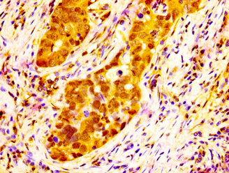 NAT10 Antibody - Immunohistochemistry image at a dilution of 1:300 and staining in paraffin-embedded human pancreatic cancer performed on a Leica BondTM system. After dewaxing and hydration, antigen retrieval was mediated by high pressure in a citrate buffer (pH 6.0) . Section was blocked with 10% normal goat serum 30min at RT. Then primary antibody (1% BSA) was incubated at 4 °C overnight. The primary is detected by a biotinylated secondary antibody and visualized using an HRP conjugated SP system.