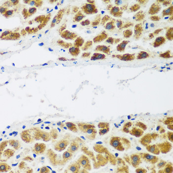 NAT15 Antibody - Immunohistochemistry of paraffin-embedded human liver cancer tissue.