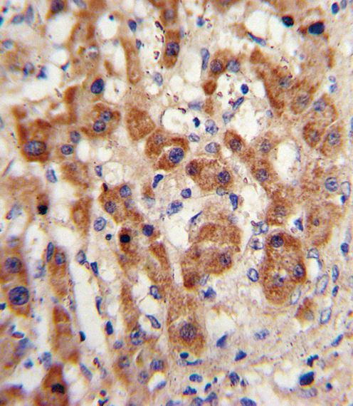 NAT2 Antibody - Formalin-fixed and paraffin-embedded human hepatocarcinoma with NAT2 Antibody , which was peroxidase-conjugated to the secondary antibody, followed by DAB staining. This data demonstrates the use of this antibody for immunohistochemistry; clinical relevance has not been evaluated.