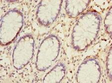 NAT2 Antibody - Immunohistochemistry of paraffin-embedded human colon cancer using antibody at dilution of 1:100.