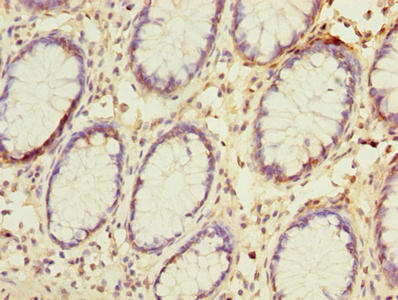 NAT2 Antibody - Immunohistochemistry of paraffin-embedded human colon cancer using NAT2 Antibody at dilution of 1:100