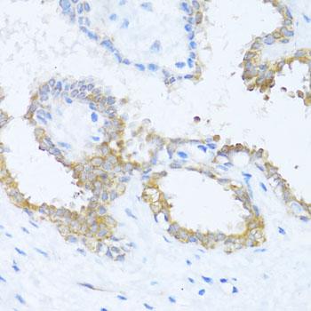 NAT2 Antibody - Immunohistochemistry of paraffin-embedded Human breast using NAT2 Polyclonal Antibody at dilution of 1:100 (40x lens).