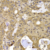 NAT5 / NAA20 Antibody - Immunohistochemistry of paraffin-embedded human oophoroma tissue.