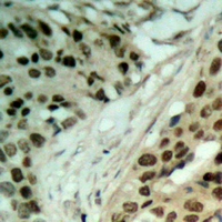 NAT5 / NAA20 Antibody - Immunohistochemical analysis of NAT5 staining in human ovarian cancer formalin fixed paraffin embedded tissue section. The section was pre-treated using heat mediated antigen retrieval with sodium citrate buffer (pH 6.0). The section was then incubated with the antibody at room temperature and detected using an HRP conjugated compact polymer system. DAB was used as the chromogen. The section was then counterstained with hematoxylin and mounted with DPX.