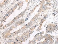 NATO3 / FERD3L Antibody - Immunohistochemistry of paraffin-embedded Human colorectal cancer tissue  using FERD3L Polyclonal Antibody at dilution of 1:75(×200)
