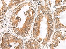 NATO3 / FERD3L Antibody - Immunohistochemistry of paraffin-embedded Human colorectal cancer tissue  using FERD3L Polyclonal Antibody at dilution of 1:85(×200)
