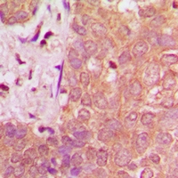 NAV1 Antibody - Immunohistochemical analysis of NAV1 staining in human breast cancer formalin fixed paraffin embedded tissue section. The section was pre-treated using heat mediated antigen retrieval with sodium citrate buffer (pH 6.0). The section was then incubated with the antibody at room temperature and detected using an HRP polymer system. DAB was used as the chromogen. The section was then counterstained with hematoxylin and mounted with DPX.