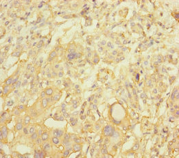NBAS / NAG Antibody - Immunohistochemistry of paraffin-embedded human pancreatic cancer at dilution of 1:100